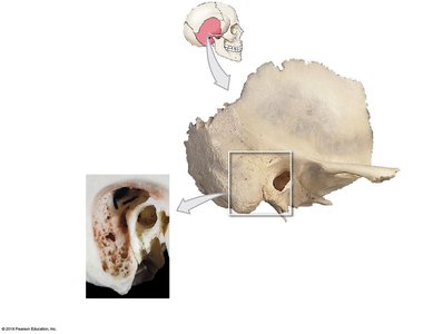 Cutaway view of the mastoid cells in the temporal bone