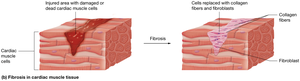 Fibrosis in cardiac muscle tissue