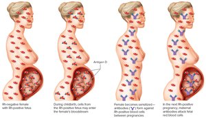 Rh incompatibility in pregnancy