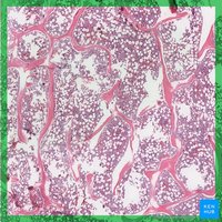 Histological section of spongy bone showing trabeculae and marrow spaces