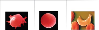 RBCs in hypertonic, hypotonic, and sickle cell conditions