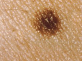 Mole (nevus) on skin