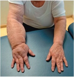 Clinical image of lymphedema in the arm