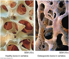 Healthy vs. osteoporotic bone
