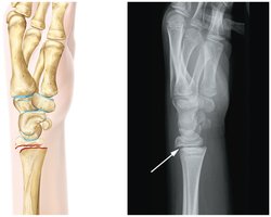 Other fracture types