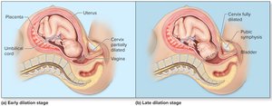 Stages of true labor and childbirth: dilation stage