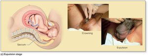 Stages of true labor and childbirth: expulsion stage
