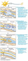Steps of peripheral nerve regeneration