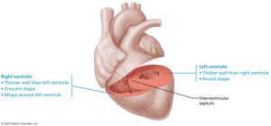 Ventricular wall thickness comparison