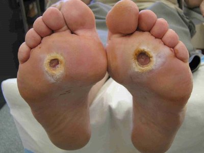 Diabetic foot ulcers, a complication of diabetes mellitus