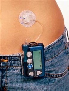Insulin pump for diabetes management