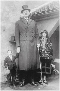 Clinical image of gigantism (GH hypersecretion in children)