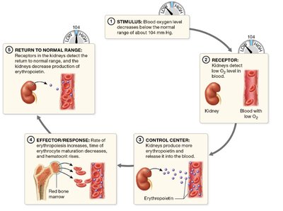 Sickle cell anemia: sickled RBCs