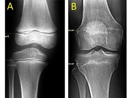Growth plate in bones