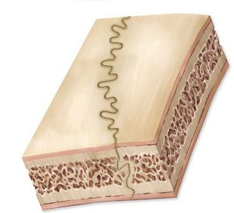 Section of bone showing a suture (fibrous joint)