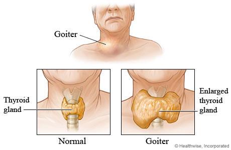 Goiter: normal vs enlarged thyroid gland
