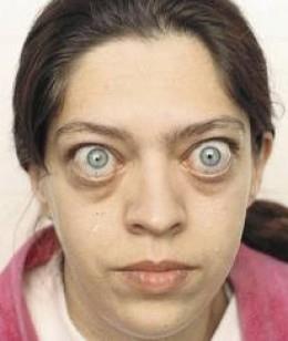 Graves' disease: exophthalmos