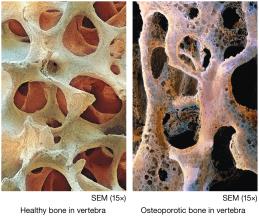 Healthy vs. osteoporotic bone