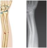 Greenstick fracture