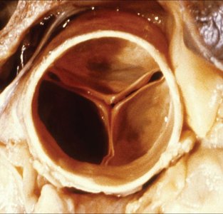 Mitral valve