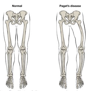 Normal vs. Paget's disease in leg bones