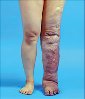 Lymphedema in the leg