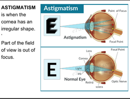 Diagram comparing astigmatic and normal eye focusing