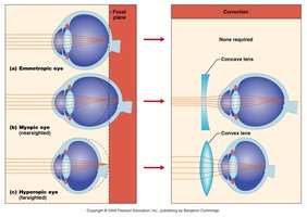 Diagram showing emmetropic, myopic, and hyperopic eyes with corrective lenses