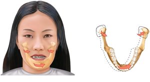 Lateral Excursion of the Mandible