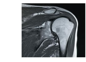 MRI Shoulder Joint, Coronal Section