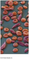 Sickle cell anemia