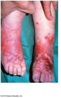 Septicemia