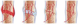 Stages of bone fracture healing