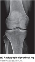 Radiograph of proximal leg