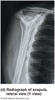 Radiograph of scapula, lateral view (Y view)