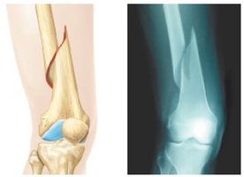 Simple fracture illustration and X-ray