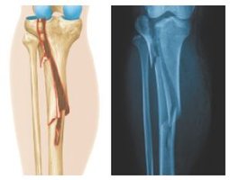 Comminuted fracture illustration and X-ray