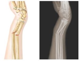 Greenstick fracture illustration and X-ray