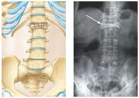 Compression fracture illustration and X-ray