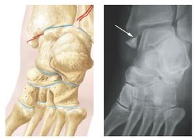 Spiral fracture illustration and X-ray