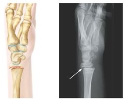Epiphyseal fracture illustration and X-ray