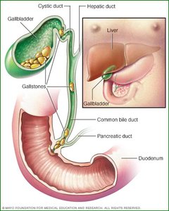 Gallstones and bile duct anatomy