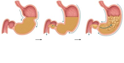 Peristaltic waves in the stomach