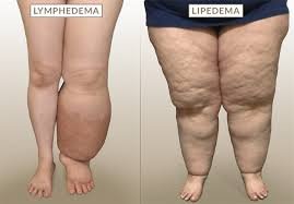 Comparison of lymphedema and lipedema in legs