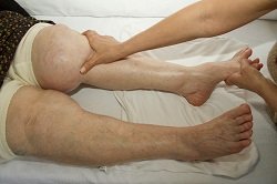 Lymphedema in the leg