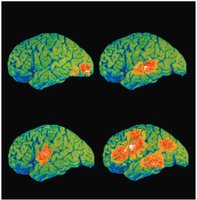 Functional neuroimaging of the cerebral cortex