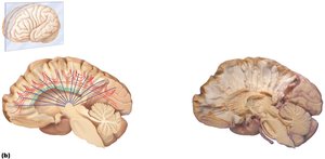 White fiber tracts of the cerebral hemispheres