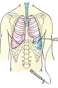 Thoracentesis procedure for pleural effusion