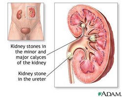 Kidney stones in kidney and ureter