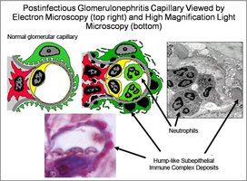 Polycystic kidney disease